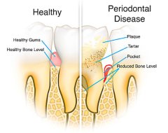 Zahnfleischcheck | schlechte Mundhygiene | Parodontitis